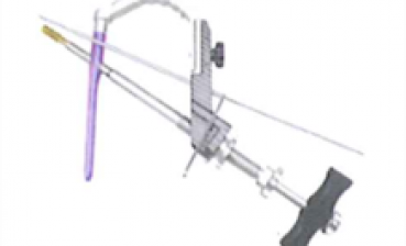 Chấn thương xương đùi